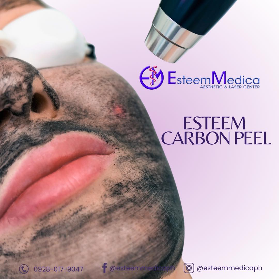 Esteem Carbon Peel