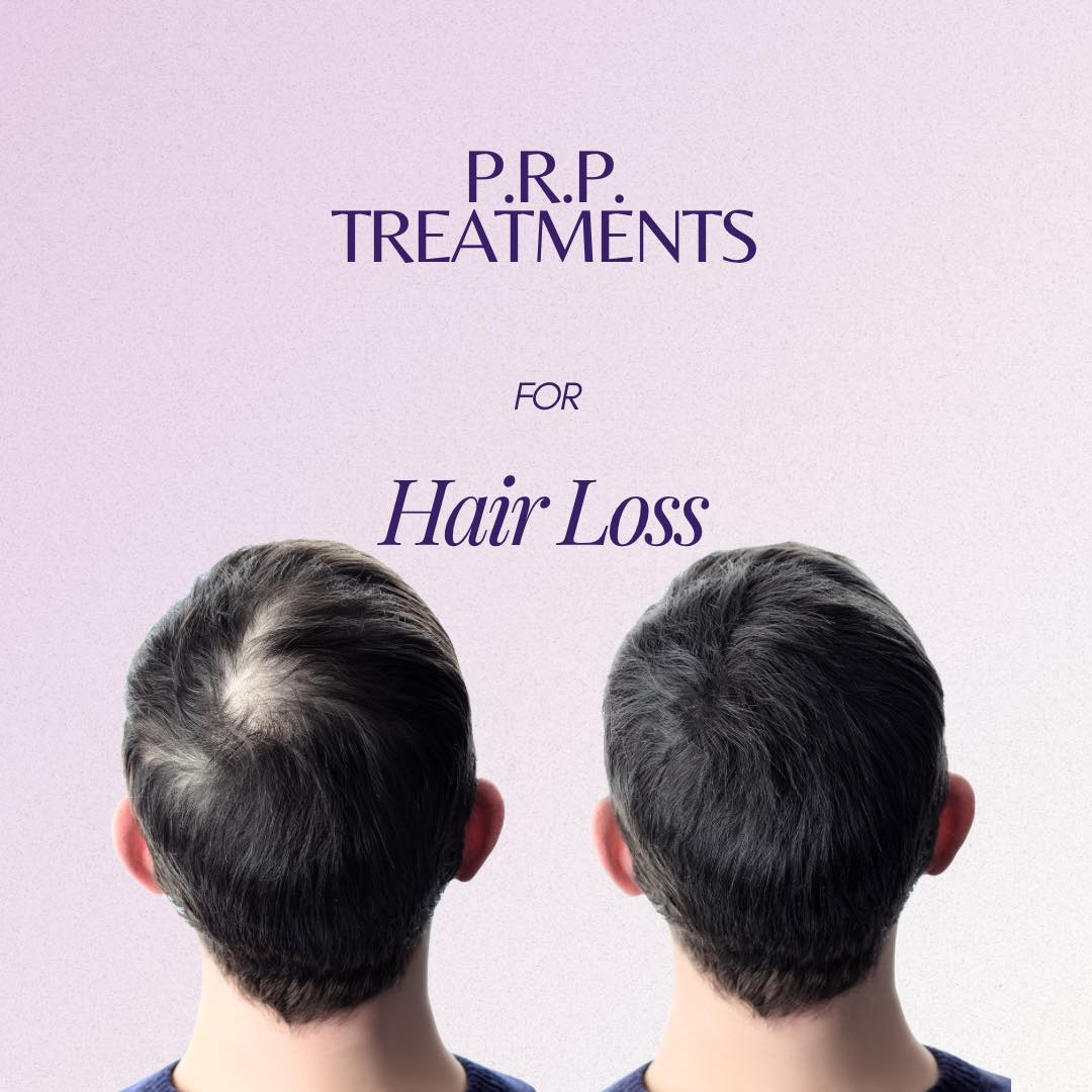 P.R.P. for Hair Loss