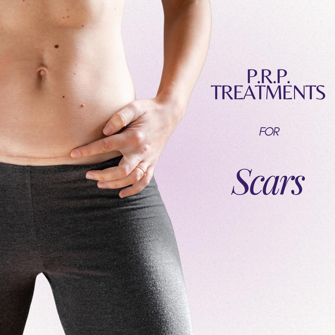 P.R.P. for Scars