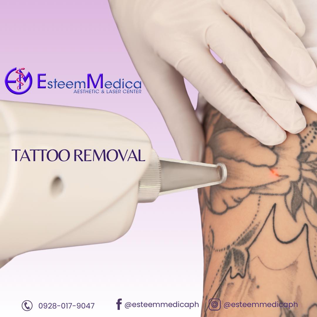 Tattoo Removal